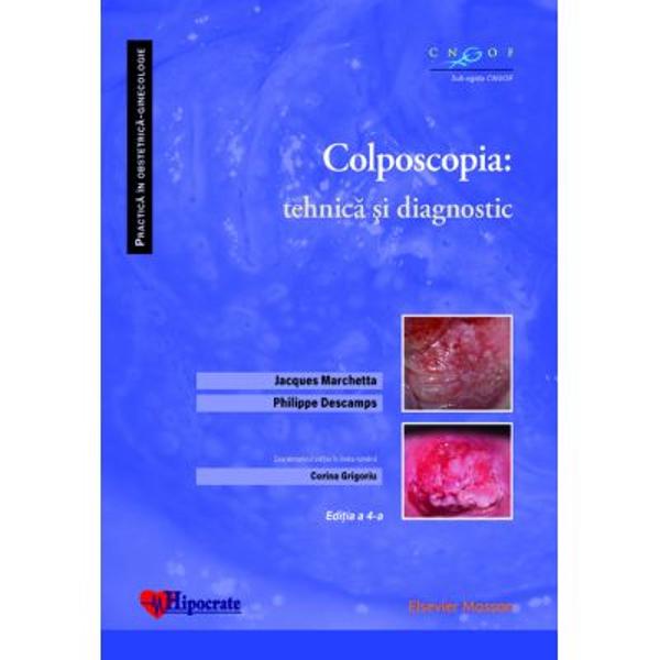 Colposcopia permite gestionarea patologiei cervico-vaginale prin în&539;elegerea clar&259; datorit&259; vizualiz&259;rii directe a fiziologiei colului &537;i a transform&259;rilor prin care trece acesta Autorii ne ofer&259; prin aceast&259; lucrare o sintez&259; a experien&539;ei lor clinice &537;i precum &537;i a celei pedagogice în colposcopie încercând s&259; ilustreze cât mai fidel posibil realitatea practicii 